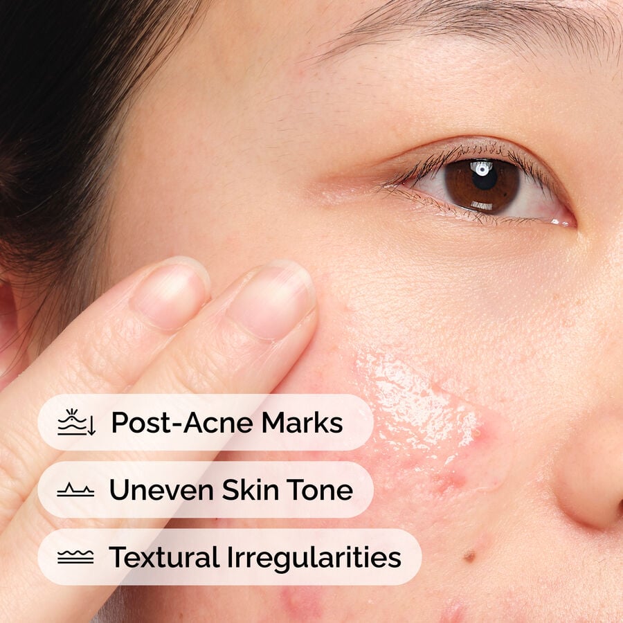 Post-Blemish Marks Serum, 2% Aloe and 2% N-Acetyl Glucosamine