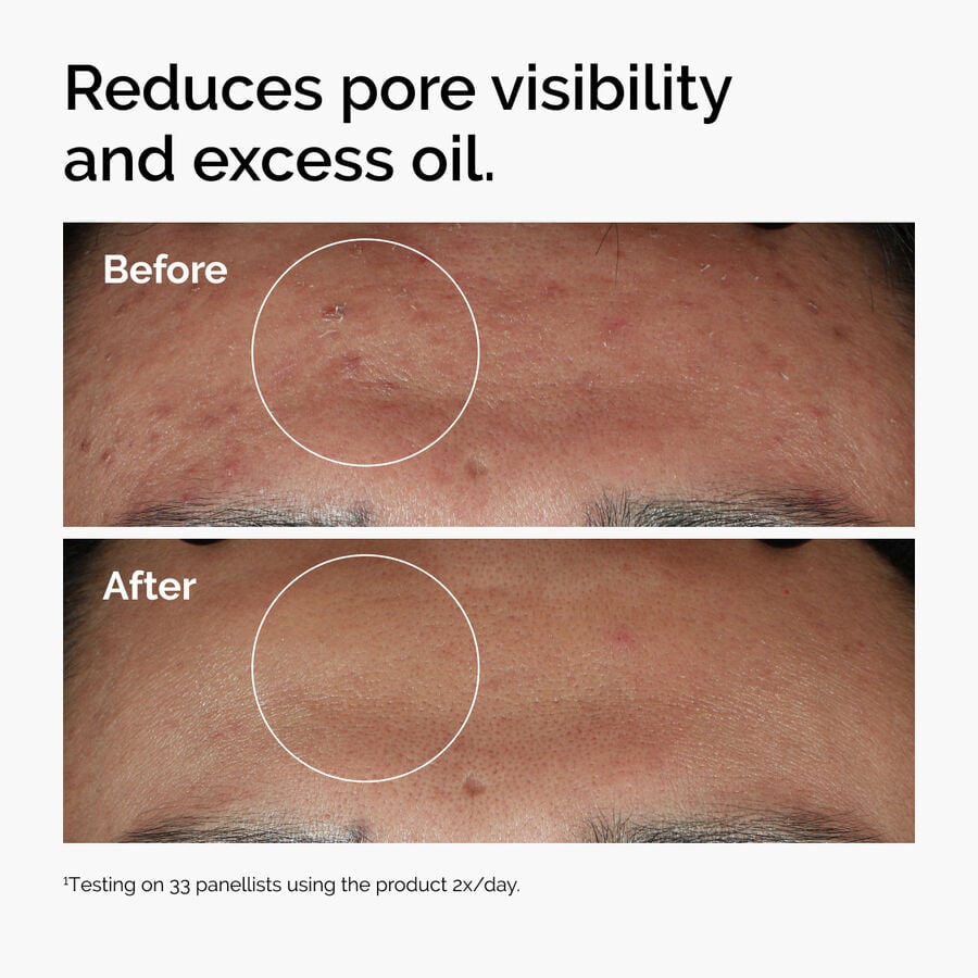 Oil-Control Serum for Blemish-Prone Skin: Niacinamide 10% + Zinc 1%