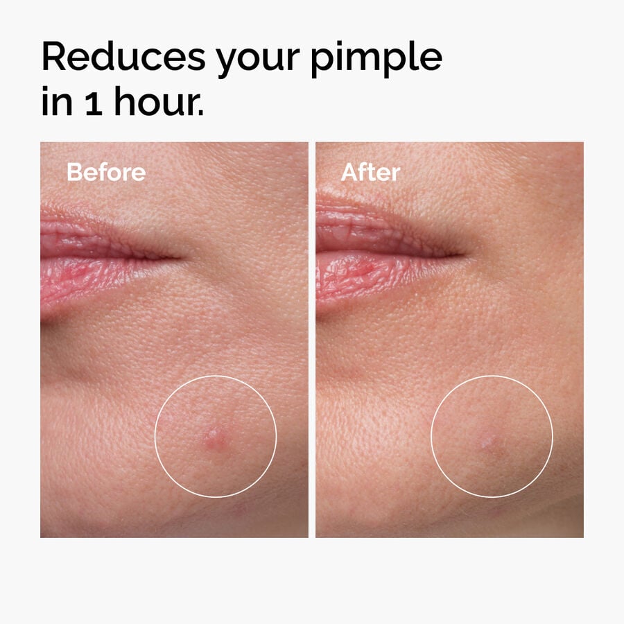 Blemish-Prone Skin Spot Formula — 10% Sulfur Powder-to-Cream